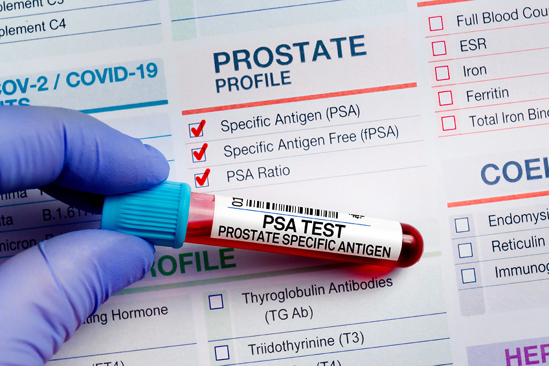 Blood sample tube for analysis of PSA Prostate Specific Antigen profile test in laboratory. Prostate Cancer Screening